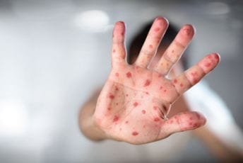 Registrovan osmi slučaj morbila u Crnoj Gori, nevakcinisani mladić hospitalizovan u KBC Kotor Registrovan osmi slučaj morbila u Crnoj Gori, nevakcinisani mladić hospitalizovan u KBC Kotor