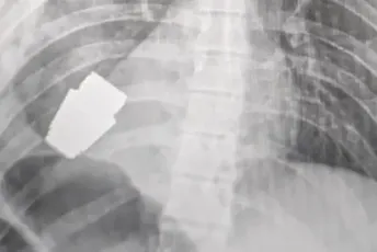 Hirurzi uklonili neeksplodiranu granatu iz grudi ukrajinskog vojnika Hirurzi uklonili neeksplodiranu granatu iz grudi ukrajinskog vojnika