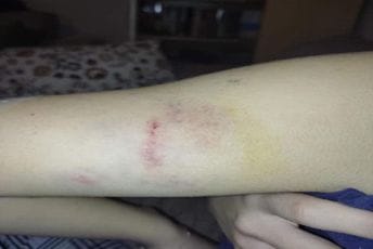 Doberman napao djevojčicu u Podgorici, roditelji najavili prijavu Doberman napao djevojčicu u Podgorici, roditelji najavili prijavu