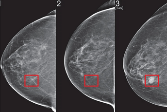 Razvijena vještačka inteligencija koja otkriva rak dojke godinama prije nego što se razvije Razvijena vještačka inteligencija koja otkriva rak dojke godinama prije nego što se razvije