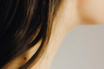 Broj oboljelih od melanoma u stalnom porastu Broj oboljelih od melanoma u stalnom porastu