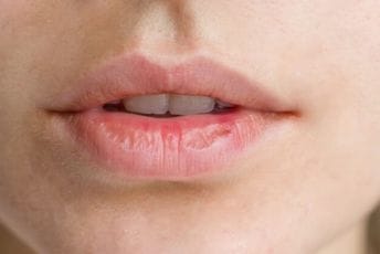 Bolesti koje možete da otkrijete pomoću simptoma koji se javljaju na usnama