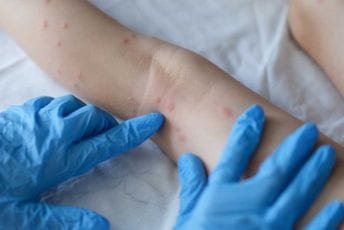 IJZ: Šuge ima u većini opština, trećina zaraženih u vrtićima IJZ: Šuge ima u većini opština, trećina zaraženih u vrtićima