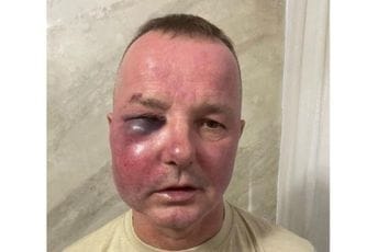 Beranac zadobio povrede tokom sinoćnje racije, podnio prijavu