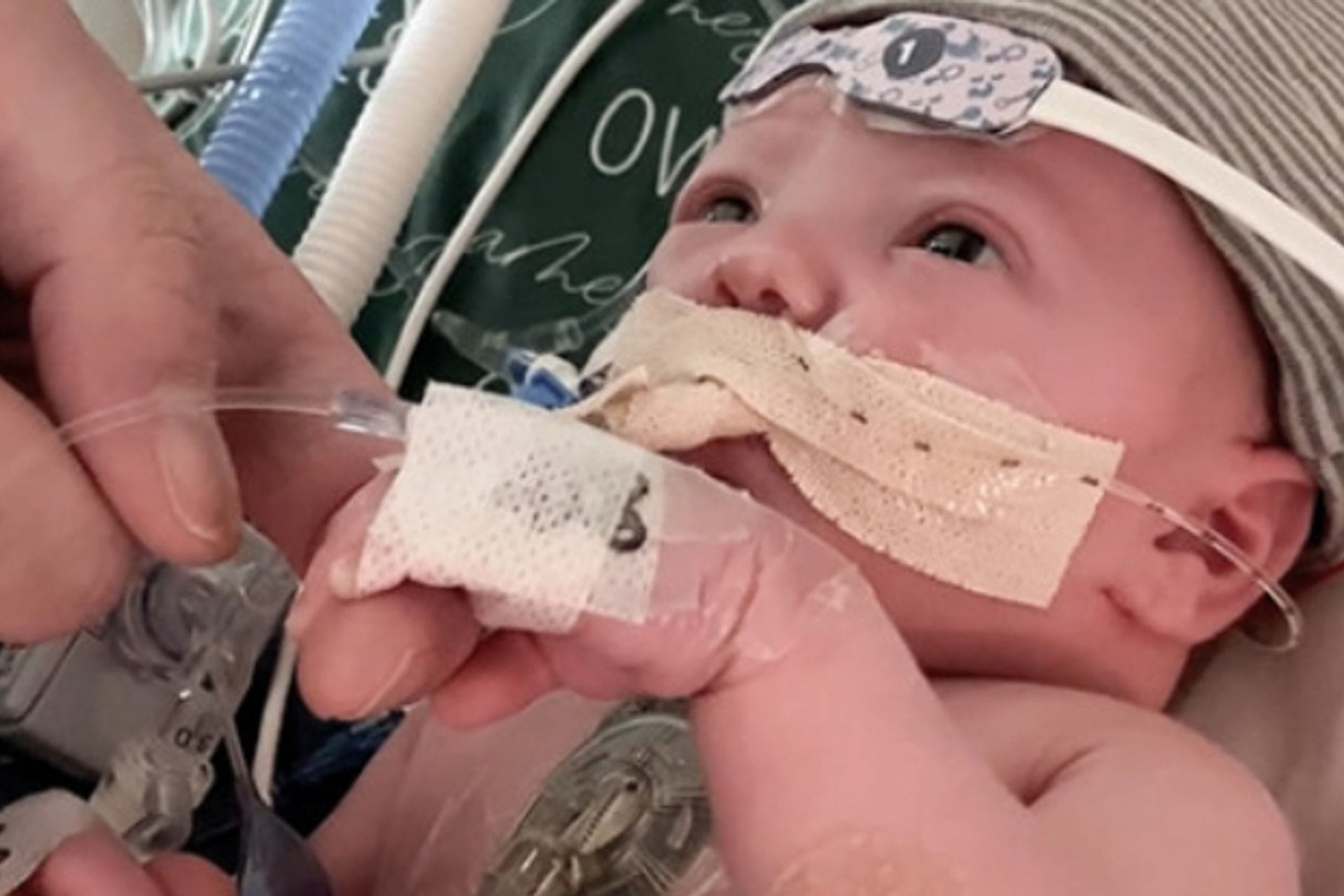 Fotografija 1: Prvi put u svijetu: Urađena djelimična transplantacija srčanog tkiva kod bebe