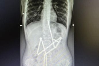 Dijete progutalo 20 magneta: Izvršena hitna operacija Dijete progutalo 20 magneta: Izvršena hitna operacija