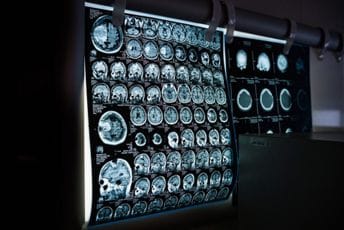 Vještačka inteligencija uči “jezik tumora” radi bolje dijagnoze