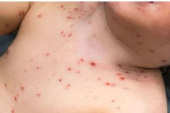 Pedijatri treba da obrate pažnju na ozbiljnije simptome Pedijatri treba da obrate pažnju na ozbiljnije simptome