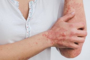 Klinika za dermatovenerologiju KCCG sjutra organizuje preglede bez uputa izabranih ljekara za pacijente sa psorijazom