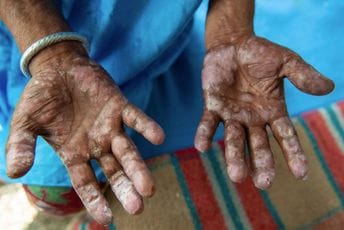 Hrvatska: Potvrđen slučaj bolesti koja je posljednji put registrovana prije 32 godine