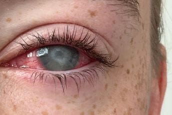 Osljepljujuća parazitska bolest oka najčešće pogađa osobe koje nose kontaktna sočiva: Evo kako da je izbjegnete