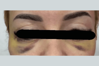 Baranka nakon estetskog tretmana lica mezonitima radila i skener glave, vlasnica salona “pod lupom” tužilaštva