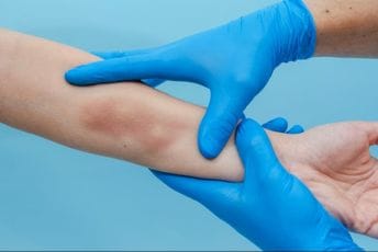 Ako vam se modrice pojavljuju "niotkuda" nedostatak jednog vitamina bi mogao da bude razlog